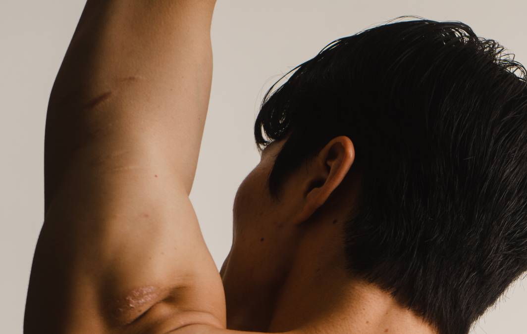The Effectiveness of Physiotherapy on Subacromial Impingement Syndrome