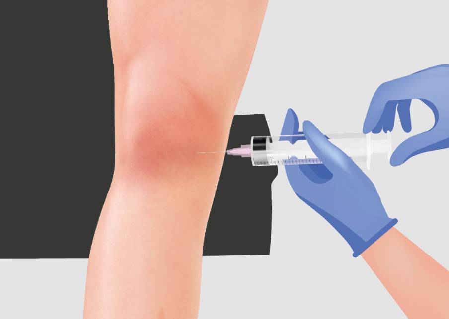 Arthrosamid® Injections